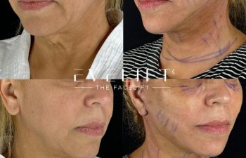 female patient before and after EVELIFT®