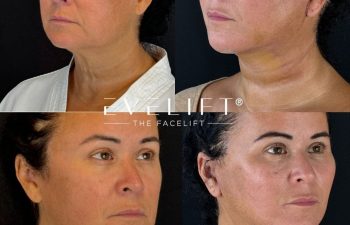female patient before and after EVELIFT®