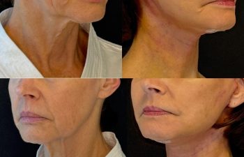 female patient before and after EVELIFT®