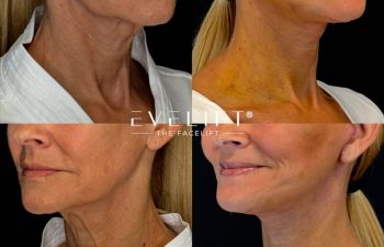 female patient before and after EVELIFT®