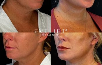 female patient before and after EVELIFT®