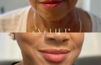 female patient before and after EVELIFT®