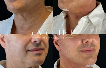 male patient before and after EVELIFT®