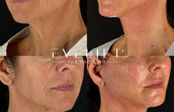 female patient before and after EVELIFT®