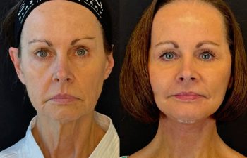 female patient before and after EVELIFT®