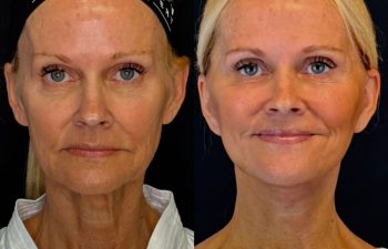 female patient before and after EVELIFT®