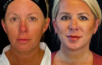 female patient before and after EVELIFT®