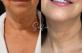 female patient before and after EVELIFT®