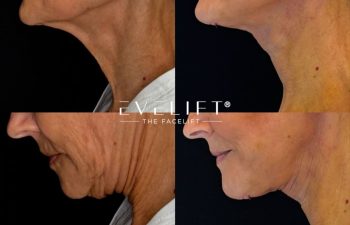 female patient before and after EVELIFT®