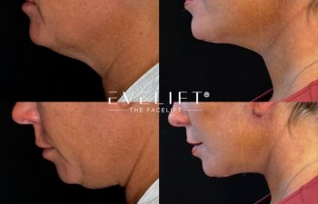 female patient before and after EVELIFT®