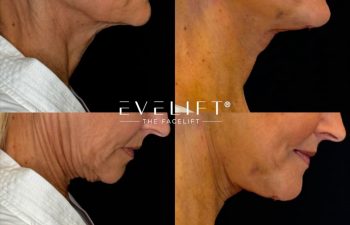 female patient before and after EVELIFT®