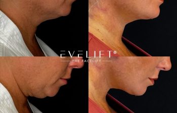 female patient before and after EVELIFT®