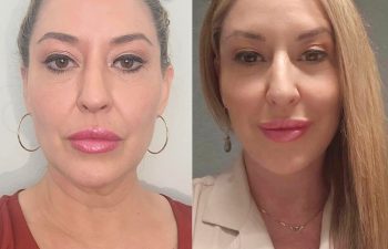 female patient before and after EVELIFT®