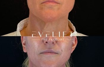 female patient before and after EVELIFT®