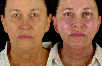 female patient before and after EVELIFT®