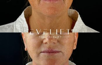 female patient before and after EVELIFT®