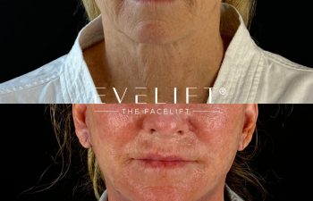 female patient before and after EVELIFT®