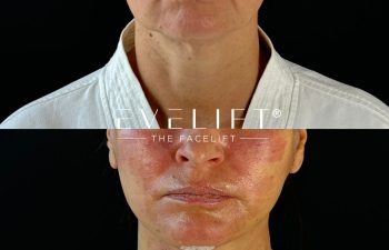 female patient before and after EVELIFT®