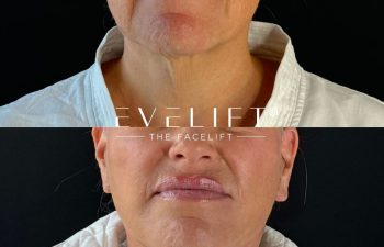 female patient before and after EVELIFT®