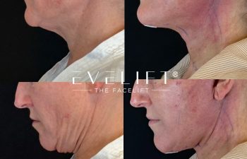 female patient before and after EVELIFT®