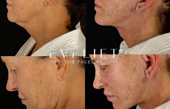 female patient before and after EVELIFT®