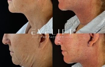female patient before and after EVELIFT®