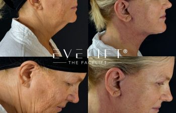 female patient before and after EVELIFT®