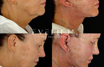 female patient before and after EVELIFT®