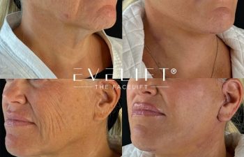 female patient before and after EVELIFT®
