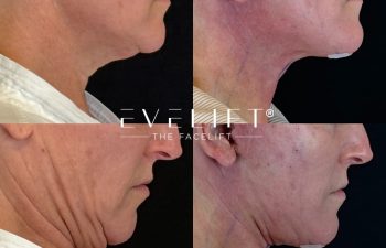 female patient before and after EVELIFT®