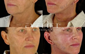 female patient before and after EVELIFT®