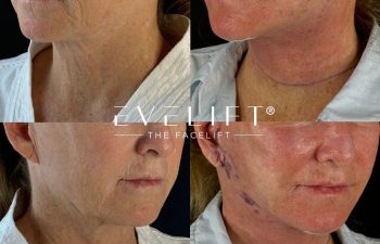 female patient before and after EVELIFT®