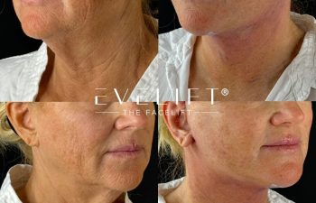 female patient before and after EVELIFT®
