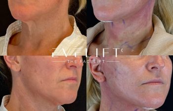 female patient before and after EVELIFT®