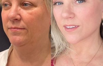 female patient before and after EVELIFT®