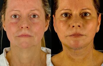 female patient before and after EVELIFT®