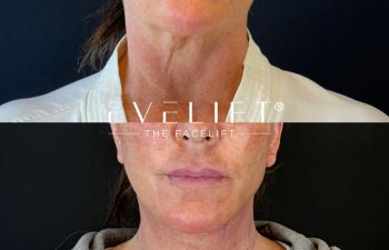 female patient before and after EVELIFT®