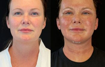 female patient before and after EVELIFT®