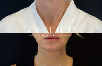 female patient before and after EVELIFT®
