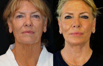 female patient before and after EVELIFT®