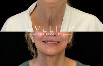 female patient before and after EVELIFT®