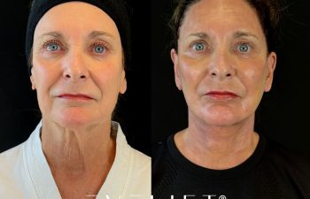 female patient before and after EVELIFT®