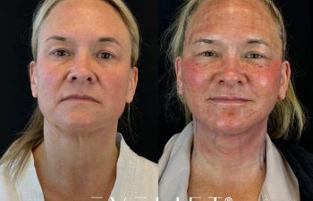 female patient before and after EVELIFT®