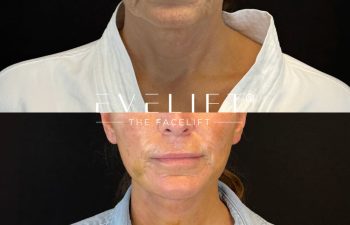 female patient before and after EVELIFT®
