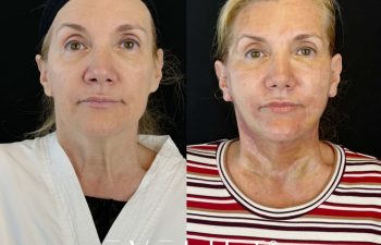 female patient before and after EVELIFT®
