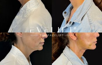 female patient before and after EVELIFT®