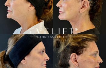 female patient before and after EVELIFT®