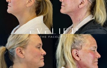 female patient before and after EVELIFT®