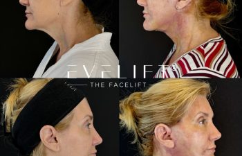 female patient before and after EVELIFT®