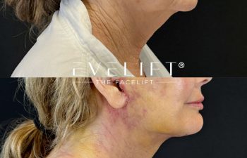female patient before and after EVELIFT®